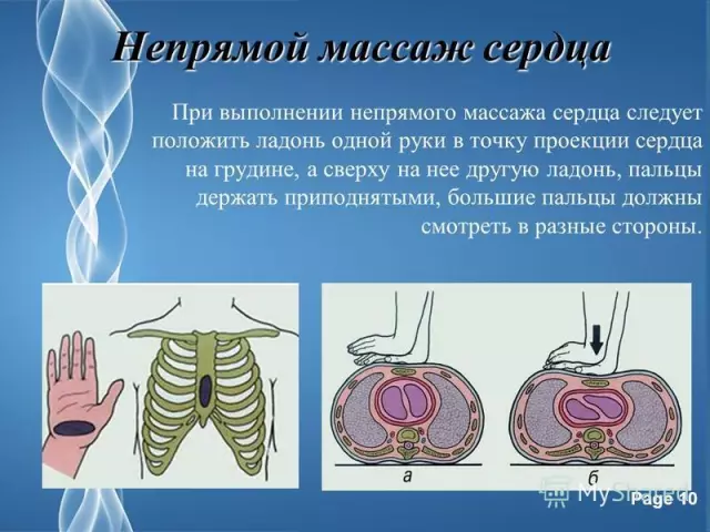 Эффективность массажа сердца в комплексном лечении заболеваний