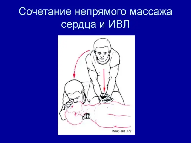 Как именно проводится непрямой массаж сердца при остановке сердечной деятельности?