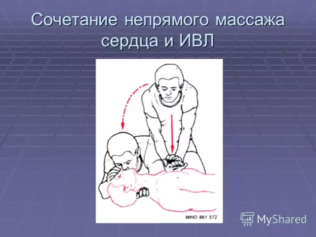 Основные показания и противопоказания для массажа сердца